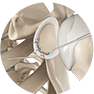 Shoulder Labral Repair