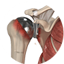 Revision Shoulder Replacement